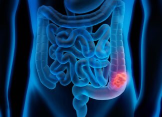 Barbosa realizará jornada gratuita para la prevención del cáncer de colon y recto Barbosa realizará jornada gratuita